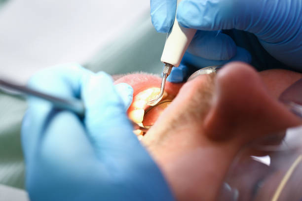 Best Broken or Chipped Tooth Repair in Almedia, PA